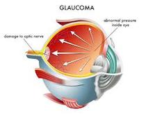 ConditionGlaucoma
